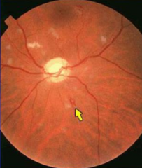 Roth spots
- Oval, pale retinal lesions
- Surrounded by hemorrhage
- Consist of lymphocytes surrounded by edema and hemorrhage
- In nerve fiber layer of retina
