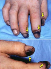 - Nontender, erythematous or hemorrhagic macules or papules
- In fingertips, palms, or soles
- Due to septic emboli