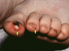 - Tender, violaceous, subcutaneous lesions in fingers or toe pads
- Inflammatory / immune complex mediated