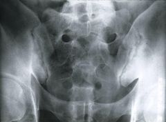 1define Sacroiliitis?
2What is SI associated with?
3Tx?
