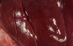 This mottled liver is an example of what type of disease?

What causes it?