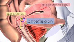 anteflexion is normally 125 degrees