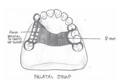 - 8 mm
- determined by edentulous space
- posterior to rugae
- perpendicular to mid-palatine suture