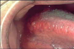 Identify the oral lesion:
Provide a differential diagnosis: