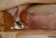 What do you tell a patient that presents with this lesion? What is the management?