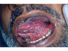 What is the etiology of this lesion?