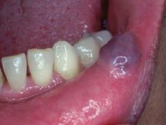 Identify the lesion:
What is the treatment?