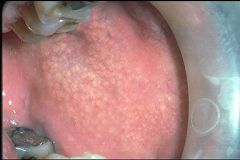 Identify the lesion:
What is the etiology?