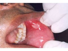 Identify the lesion:
How would you treat it?