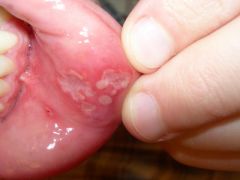 Identify the lesion:
This lesion has been identified in patients with which other conditions/ syndromes?