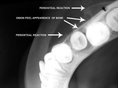 OSTEOMYELITIS ("onion" ring osteolysis are the tell-tale signs of this condition)