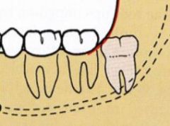 What kind of classification of third molar impaction is this?