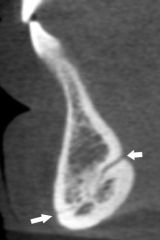 Identify the radiolucent structure pointed at by the arrows?