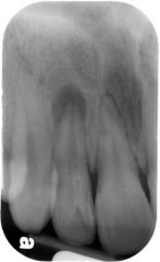 The periapical radiolucency around the #12 is most likely resulting from what anomaly?