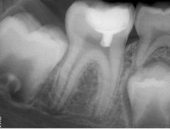 Identify the procedure that was performed on the molar: