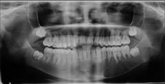 Give a differential diagnosis for a:
MULTILOCULAR
RADIOLUCENCY
OF THE JAWS