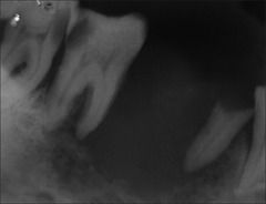 Give a differential diagnosis for a:
ILL-DEFINED RADIOLUCENCY IN THE JAWS