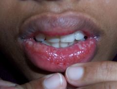 This child present to you with ulcerations on the oral mucosa and surrounding areas. They are very painful and some of the blisters have already ruptured. What is your diagnosis?