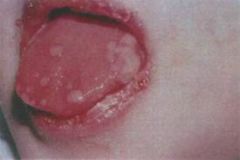This child present to you with ulcerations on the oral mucosa and surrounding areas. They are very painful and some of the blisters have already ruptured. What is your diagnosis?