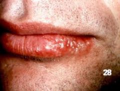This adult presents with a "cold sore" on the lip. They say that this happens once or twice a year. What do you tell the patient?
