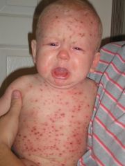 What virus is this child infected with?