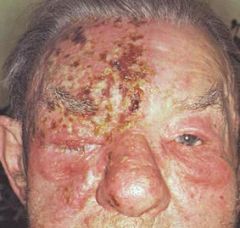 This elderly man has a positive history for chickenpox in his childhood. He presents with this severe condition strangely following unilateral trigeminal distribution. What is your diagnosis?