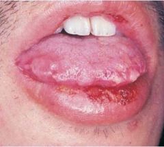 Identify the lesion: