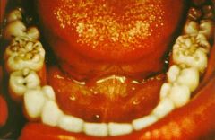 Identify the dental abnormality: