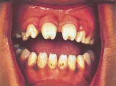 Identify the dental abnormality: