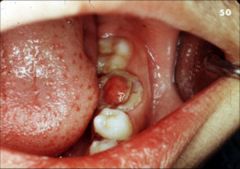 Identify the inflammatory lesions: