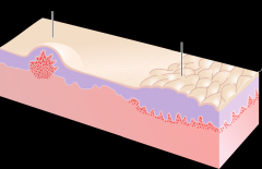 A plaque has been described as a broad papule, or confluence of papules equal to or greater than 1 cm.
