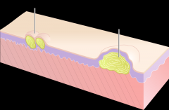 A vesicle is a circumscribed, fluid-containing, epidermal elevation generally considered less than either 5 or 10 mm in diameter at the widest point