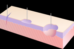 An erosion is a discontinuity of the skin exhibiting incomplete loss of the epidermis