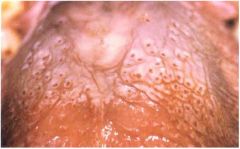 Identify the benign epithelial lesion: