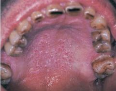 Identify the benign epithelial lesion: