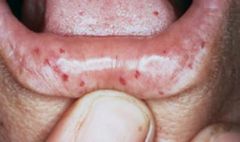 Identify the dermatologic condition:
