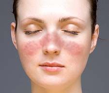 Identify the dermatologic condition:
