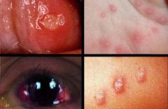 Identify the following allergic condition:
