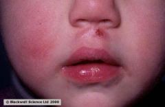 Identify the following allergic condition: