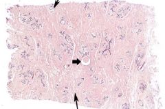 Identify the tissue and structures denoted by thin arrows.  What pathological structure is indicated by the thick arrow?