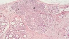 The alveoli differentiates and fat and protein droplets appear in alveolar cells. In some alveoli you may see a characteristic "apocrine snout." You will also see fat accumulation in the apical cytoplasm. Overall appearance is really crowded lobules that 