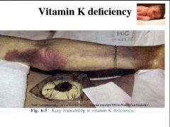 Vitamin K deficiency leads to increased prothrombin time which is associated with easy bruisability. Recall Vitamin K antagonists are given in anticoagulant therapy to prevent thromboembolism.