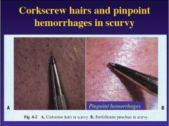 Scurvy; it is a defect in collagen synthesis. Symptoms: corkscrew hairs, impaired wound healing, malformed teeth, and capillary rupture.