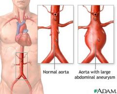 permanent localized dilation of an artery, with an increase in diameter of 1.5 times its normal diameter