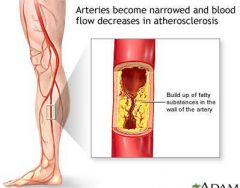 a disease of the arterial vessels marked by thickening, hardening, and loss of elasticity in the arterial walls