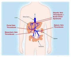 thrombosis of the hepatic veins