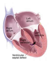 Communication between the right and left ventricles.