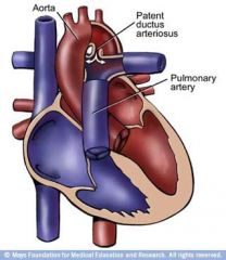 The ductus arteriosus fails to constrict after birth.