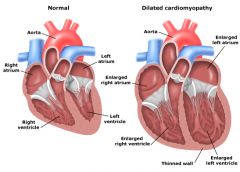 False. Regarding dilated cardiomyopathy, there is FOUR-chamber hypertrophy and dilation of the heart in a GLOBOID shape.