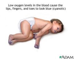 Arterial oxygen level is lower than normal.

Patients look blue (cyantotic).